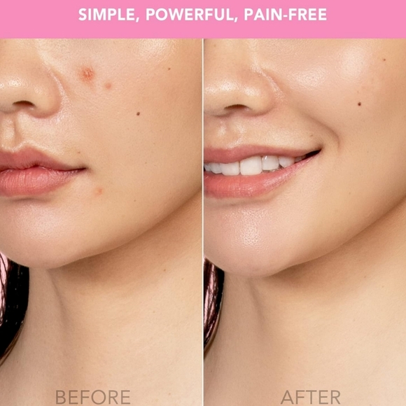 FOREO ESPADA LED Light Acne Treatment Device Pink NIB - Picture 6 of 12